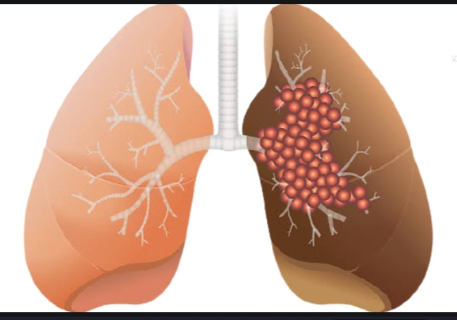 Symptoms of lungs cancer