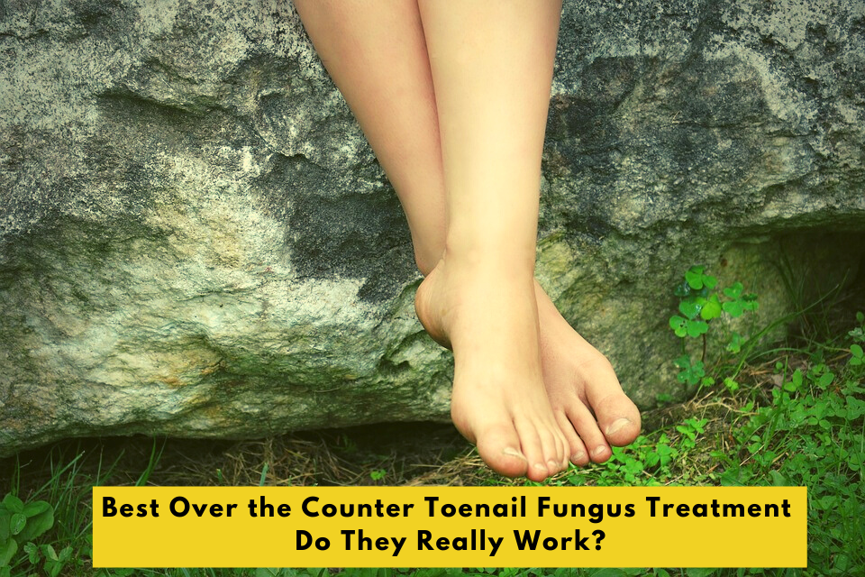 Best Over the Counter Toenail Fungus Treatment - Do They Really Work?