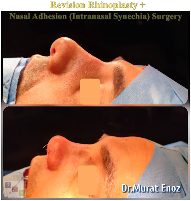 Intranasal Synechia, Revision Nose Job in Men Istanbul,Complicated Secondary Revision Rhinoplasty, Nasal Septal Spur Removal,bone spur formation,