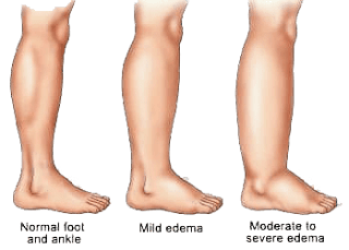 Edema: Causes and treatment