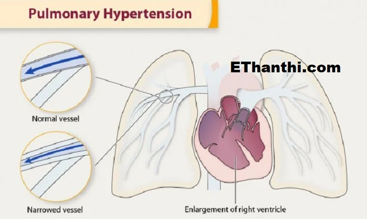 இதயத்தில் பல்மனரி வால்வு அடைப்பு ஏற்பட்டால் என்னவாகும்?
