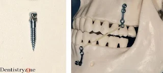 mini implants or temporary anchorage devices (TADs)