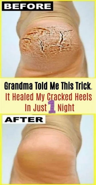 Grandma Told Me This Trick. It Healed My Cracked Heels In Just 1 Night