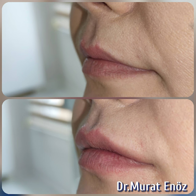 Lip Filler Injection - Augmentation in Istanbul