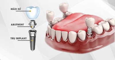 Quy trình cấy ghép implant như thế nào? 3