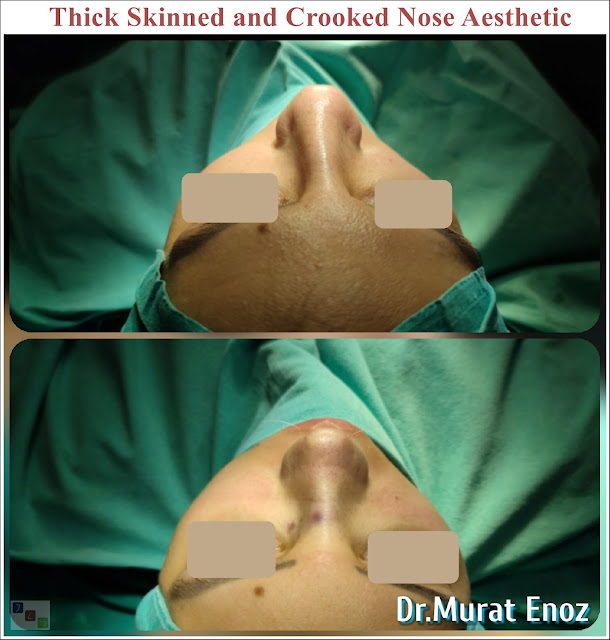 Crooked Nose Aesthetic Surgery in Istanbul,Twisted Nose Rhinoplasty,