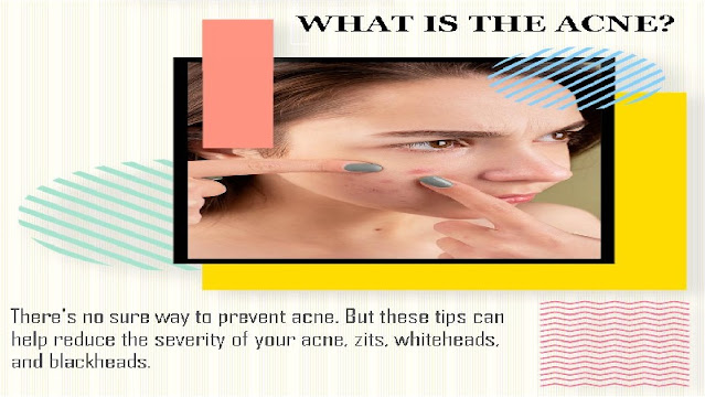 How to prevent acne Tip and Treatments.