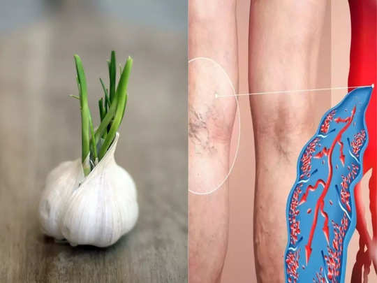 Garlic benefits अंकुरित लहसुन 5 गंभीर बीमारियों की रामबाण औषधि है..