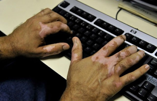  [Agora é Lei] Paciente com vitiligo passa a ter novos direitos