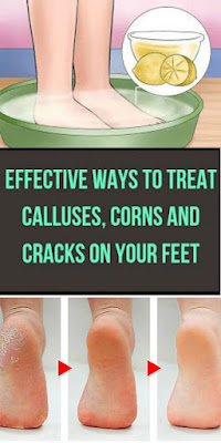 Effective Ways to Treat Calluses, Corns and Cracks on Your Feet