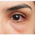 Eyes Infection | Types, Causes and Treatment