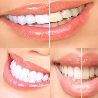 amazing smiles teeth whitening