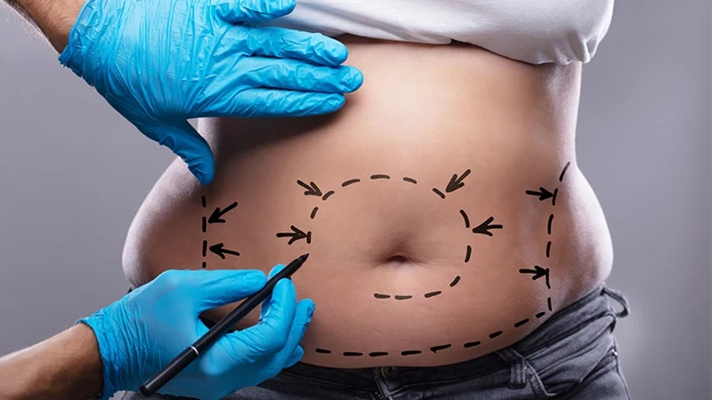 Liposuction kadınlar kadar erkekler tarafından da tercih ediliyor