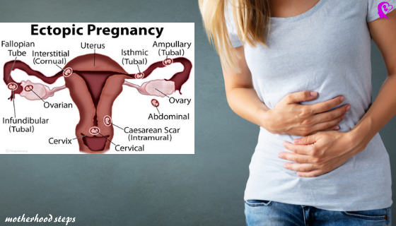 Ectopic-Pregnancy-Causes-Symptoms-Treatments