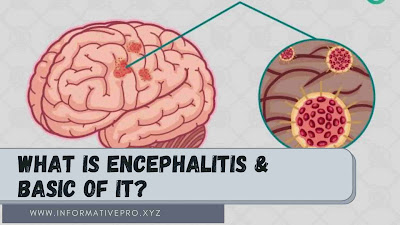 what is encephalitis and how to treat it.