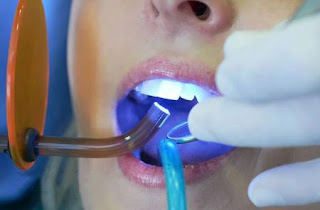 Quy trình tẩy trắng răng tại nha khoa-1