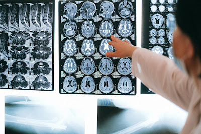 Status Epilepticus Pipeline Comprehensive Insight and Therapeutic Assessment Reviewed in 2017