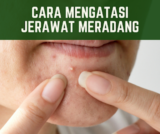 Cara Mengatasi Jerawat Meradang  dengan Bahan-Bahan Alami