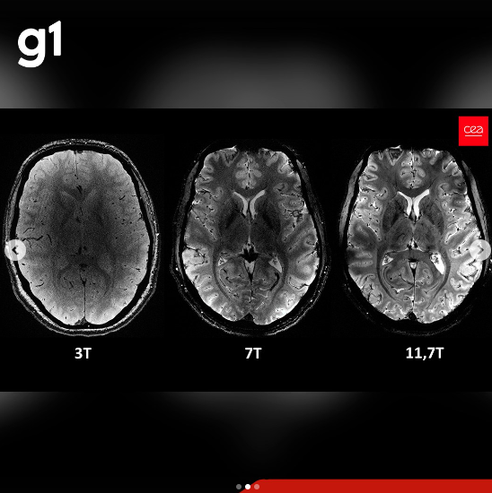 Avanço: Primeiras Imagens do Cérebro Humano com Scanner de Ressonância Magnética Mais Potente do Mundo