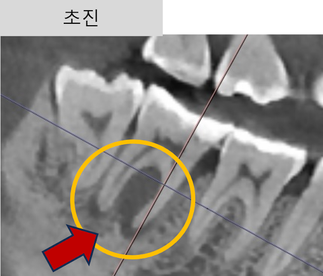치수괴사 진단, 치근단염, CT 사진