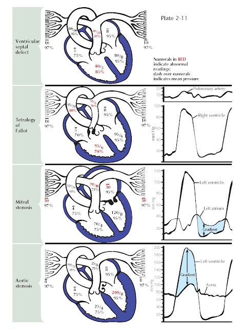 EXAMPLES OF O2 AND PRESSURE FINDINGS AND PRESSURE TRACINGS IN HEART DISEASES