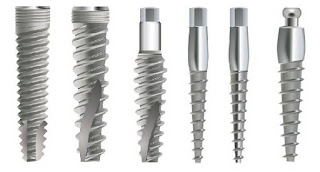 Quy trình cấy ghép răng implant-1