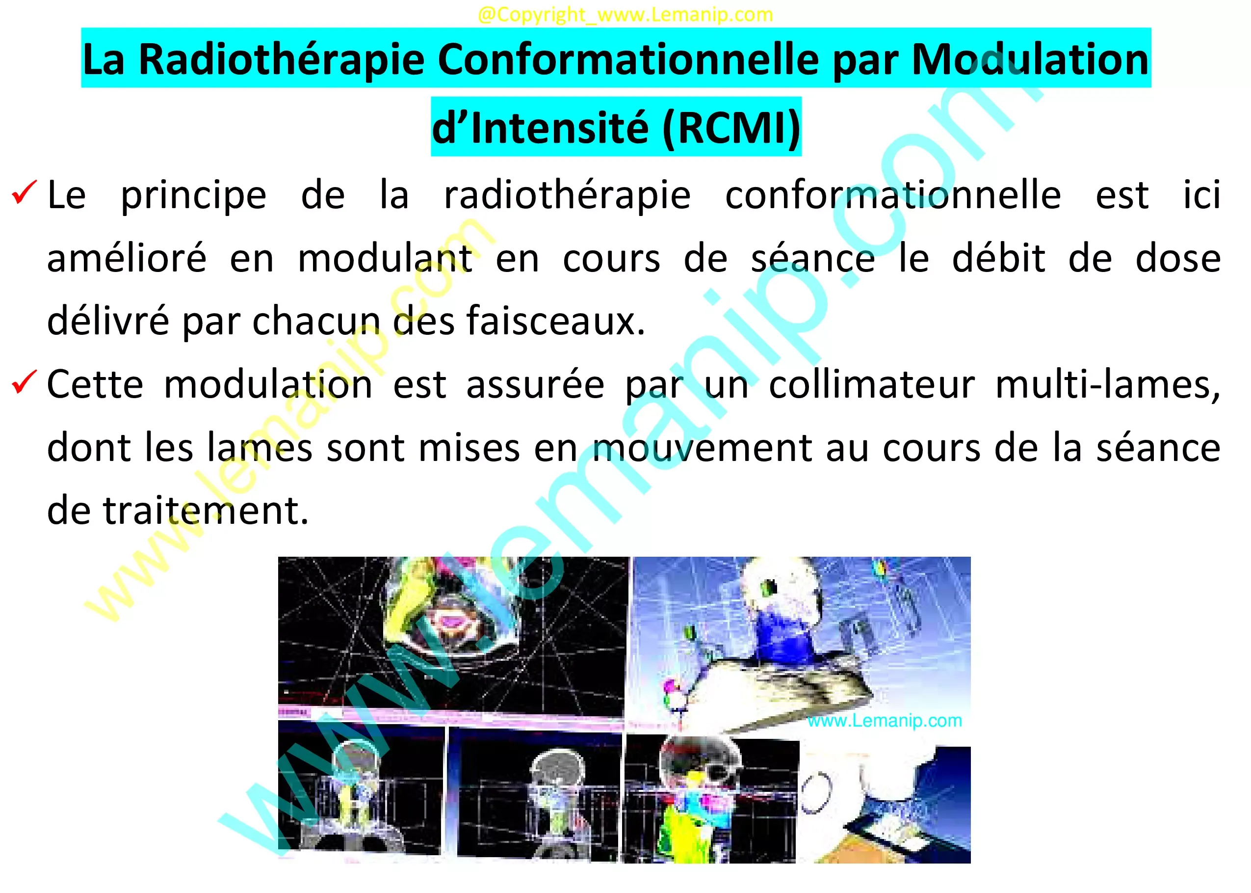 Radiothérapie Conformationnelle par Modulation d’Intensité (RCMI)