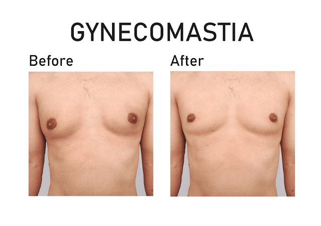 Remedies to treat gynecomastia