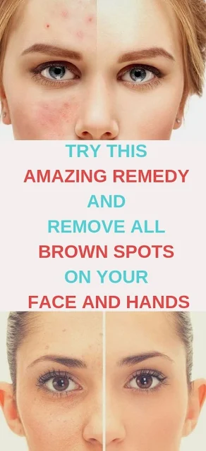 Try This Amazing Remedy And Remove All Brown Spots On Your Face And Hands
