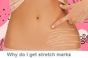 Why do I get stretch marks