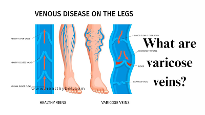 Say Goodbye to Varicose Veins: Effective Remedies for Healthy Legs