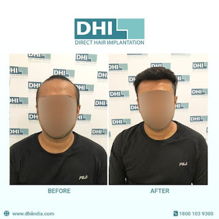 Hair transplant in chennai