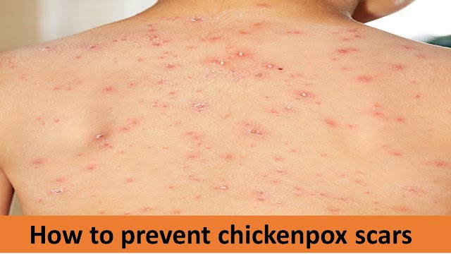 How to prevent scarring from chickenpox 