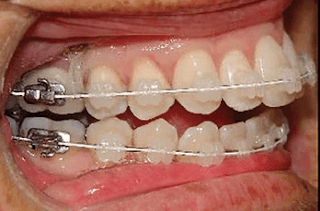 Quy trình niềng răng tại nha khoa