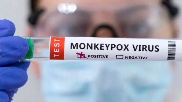 Viruela del mono: Confirman primera muerte a causa de este virus en el Perú