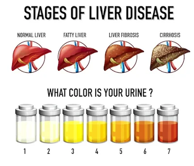 What causes changes in urine color - Healthy Bel