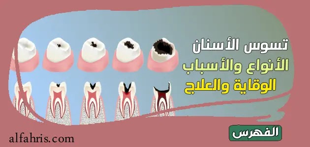 أنواع تسوس الأسنان أسبابه وكيفية الوقاية والعلاج الفوري