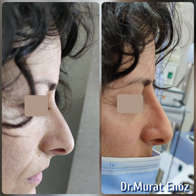 Cost of non-surgical rhinoplasty in Istanbul,Nose filler injection cost in Turkey,Cost of non-surgical nose job in Istanbul,Cost of non surgical nose job with filler in Istanbul,