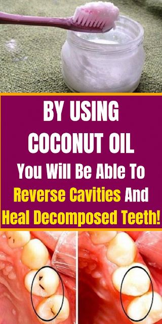 Use Coconut Oil To Reverse Cavities And Heal Decomposed Teeth!