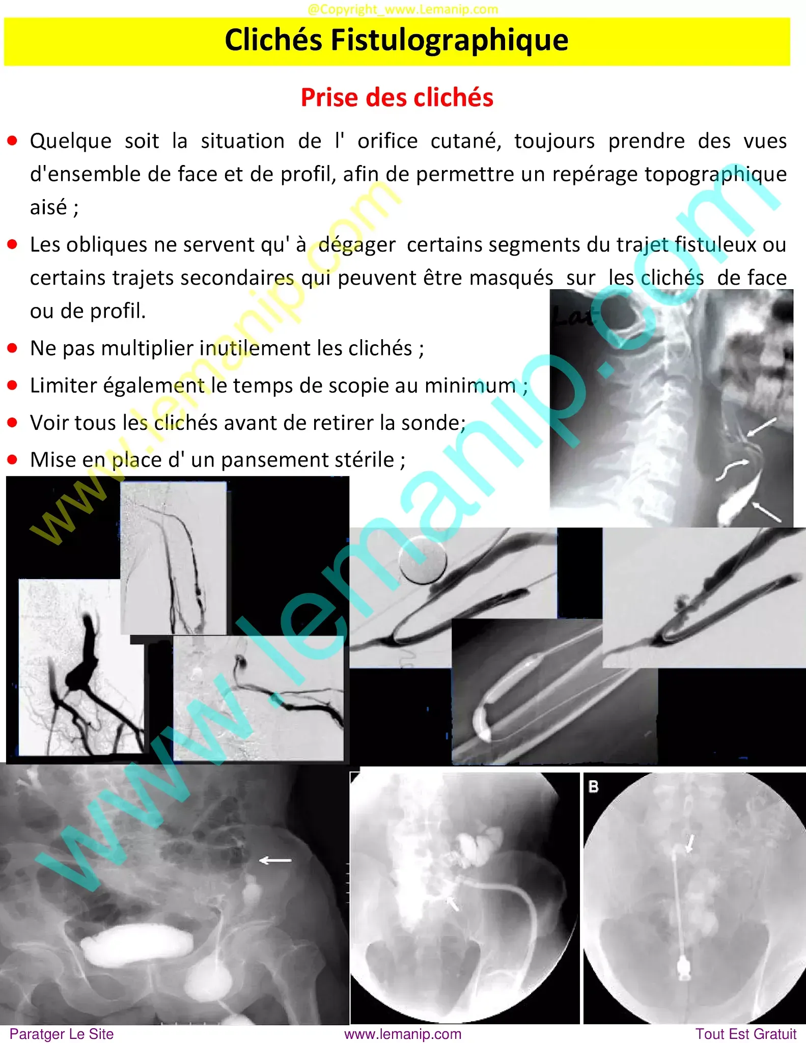 av fistula in leg for dialysis,perianal crohn's disease treatment,hemodialysis fistula,av fistula for hemodialysis,fistula in arm,av fistula,atrioventricular fistula,spinal fistula surgery,av fistula for dialysis,gum fistula