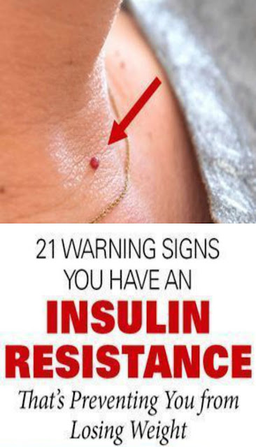 21 Warning Signs You Have An Insulin Resistance That’s Preventing You From Losing Weight