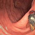 Em caso raríssimo, médicos descobrem mosca viva e intacta dentro do intestino de idoso