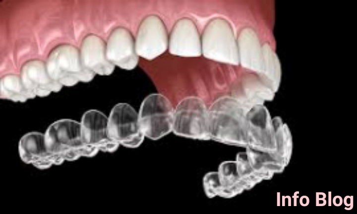 How much is invisalign