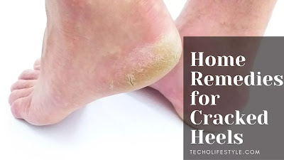 Home Remedies for Cracked Heels