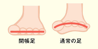 開張足と普通の足の違いを表すイラスト。詳細は以下の通り。