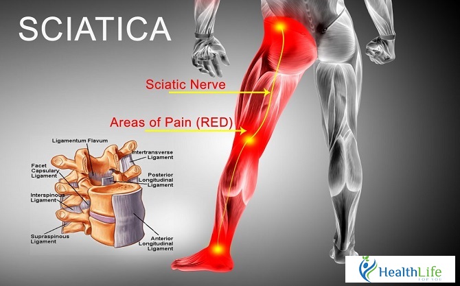 Answer your concerns about sciatica