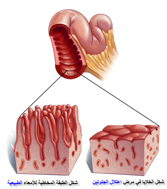 شكل خلايا الأمعاء في حالات مرض الاضطرابات الهضمية (اعتلال الجلوتين) - Celiac disease