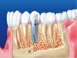 Vì sao không thể cấy ghép implant giá rẻ-1