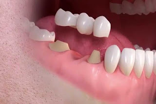Làm cầu răng sứ có tốt không khi bị mất 2 răng?-2