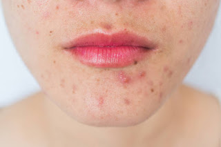 Here are some natural recipes, which can help get rid of acne scars, or reduce them
